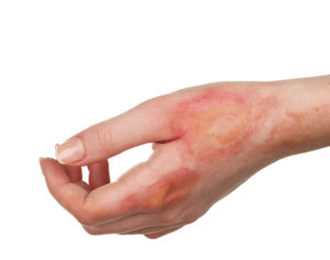 Read more about the article Most Common Types of Burn Injury Scenarios 