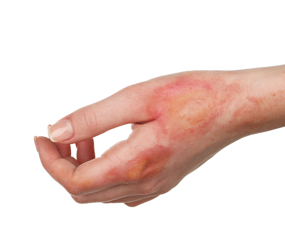 You are currently viewing Most Common Types of Burn Injury Scenarios 